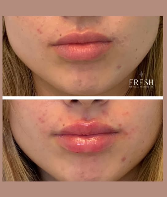 Have you been thinking about lip filler… but nervous it’s going to change the way you actually look?