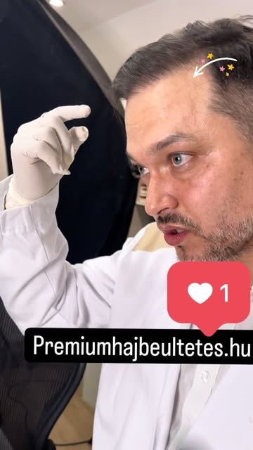 ▶️ A hajbeültetésben a donor dominancia azt jelenti, hogy az átültetett haj az adóterület (donor-ter