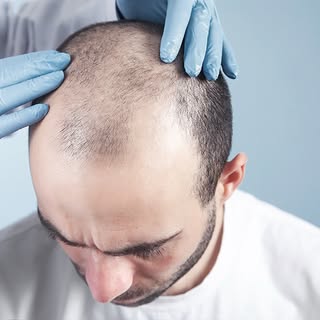 🧔🏻‍♂️A hajhullás elleni harc egyik leghatékonyabb fegyvere a modern hajbeültetési technológia. Mié