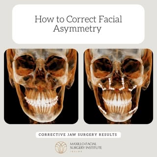Correcting facial asymmetry isn’t magic—it’s method ✨ 

#oralsurgery #omfs #omfsresident #oralandmax