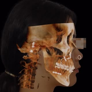 Another Jaw Asymmetry post for today!

🎥 This patient presented with significant jaw asymmetry, aff