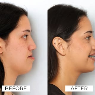 Before and after: the impact of orthognathic jaw surgery

LeFort I Maxillary Advancement
BSSO Mandib