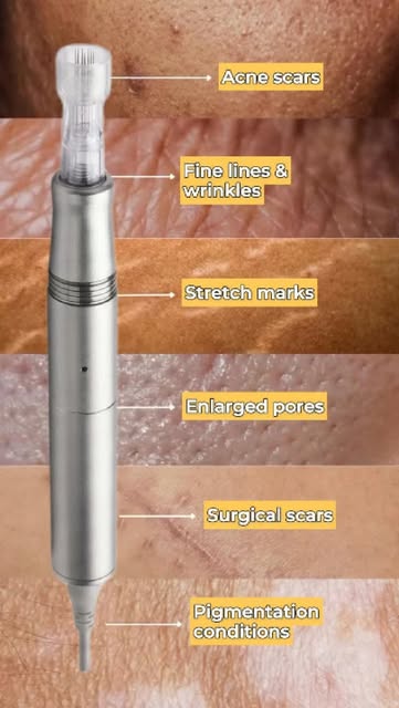 Tiny needles. Big skin benefits. ✨

Microneedling stimulates collagen to improve the appearance of:
