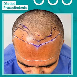 Cuando el cabello falta en la zona frontal, la imagen cambia por completo.
Y si siempre tuviste buen