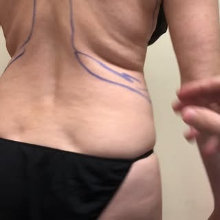 Renuvion ( J plasma ) 20 second pinch test video by Dr Varano . Shows before & after skin tightening