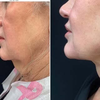 Another great #renuvion #jplasma  neck result one week post treatment ☎️202-621-8675#skintightening 