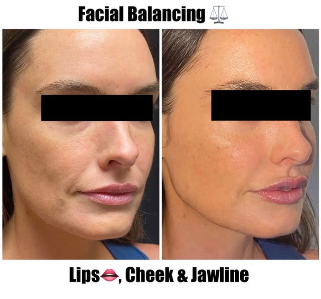 Nice facial balancing results from our Nurse injector  Ansley.  Fuller  but not over done Lips , sha