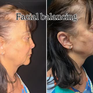 Facial balancing with dermal fillers. Jawline definition and pre jowl sulcus help define the neck /m