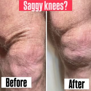 Do you have saggy knees? We come to please … or skin creapiness? Hyperdilute Radiesse injections can