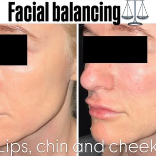 Another facial balancing patient where we enhanced her lips with subtle more pucker 👄💋to look natu