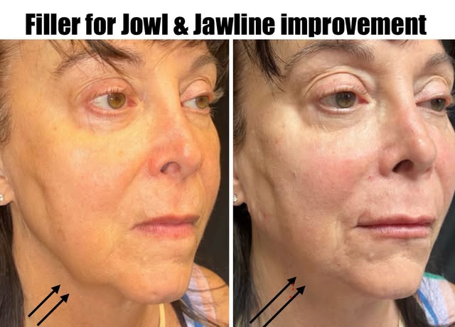 Treating Jowls can be performed surgically and non surgically.. this was performed with dermal fille