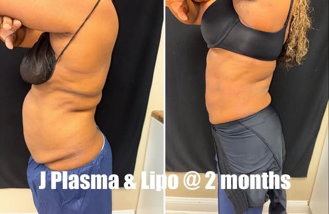 Liposuction 2 months before and after. Almost 5 inches circumference off abdomen combined with J Pla