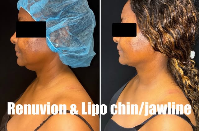 Chin and jawline definition with liposuction combined with Renuvion aka J Plasma..minimal recovery t