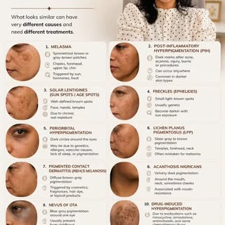 Looks similar. Isn't the same.
When it comes to facial pigmentation, one treatment doesn't fit all. 