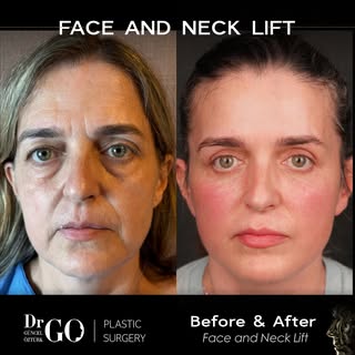 We are pleased to present the before and after photos of our esteemed patient, taken eight months af