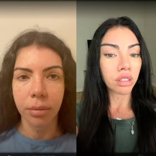 Seven days and three weeks post-op, we’re delighted to see how beautifully the early results are tak