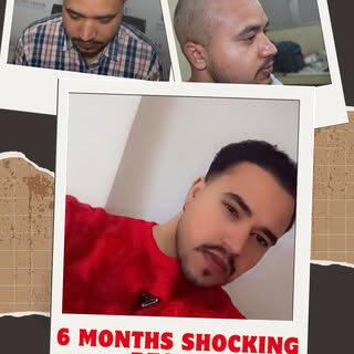 Meet Mr. Ashu from Ludhiana  It’s been 6 months since his hair transplant, and the transformation sp