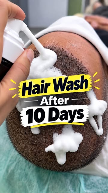 Hair Wash After 10 Days 🧴
10 days after a hair transplant, proper scalp care is an important part o