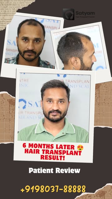 6 months after his hair transplant, Mr. Jitender from Ludhiana came back to share his experience.

T