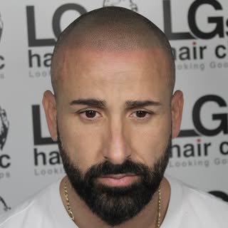 The difference a hairline can make 👀 swipe left for the before photo… 

Interested in the treatment