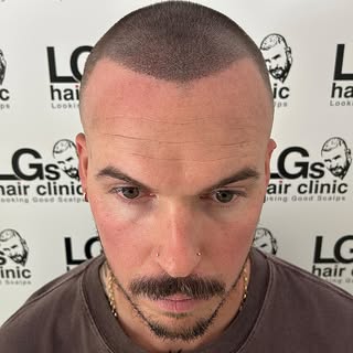 Thinning hair? No problem 🤝🏼 we added more density to this clients hairline and crown area, creati