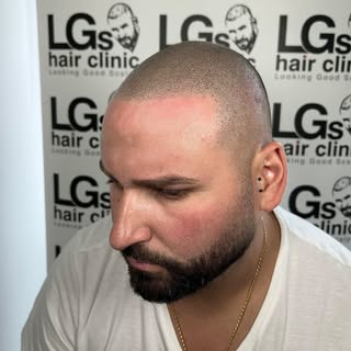 Done deal 🤝🏼 hairline and confidence restored 

Ready to say goodbye to baldness? Send photos of y