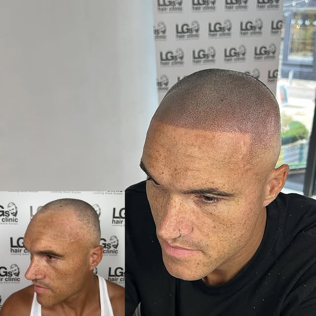 Hairline restored and back in the game 🔥 not too sharp, but enough to stand out ✔️

Photos taken st