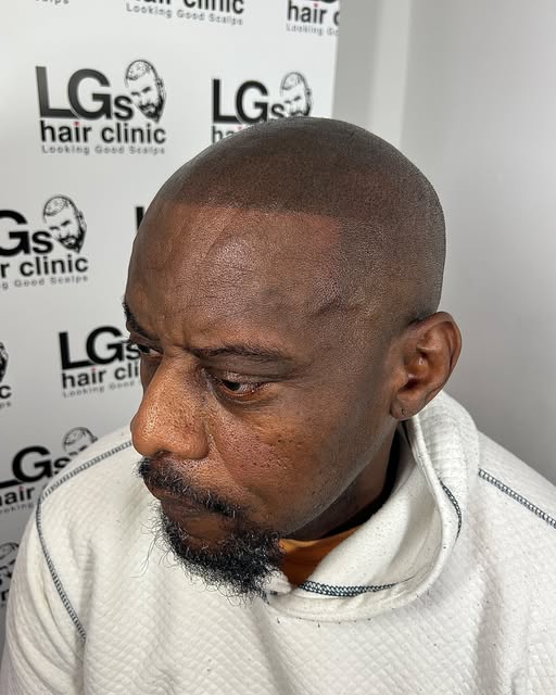 The younger look 👀 what a difference having a hairline makes… start your SMP journey now 

Interest