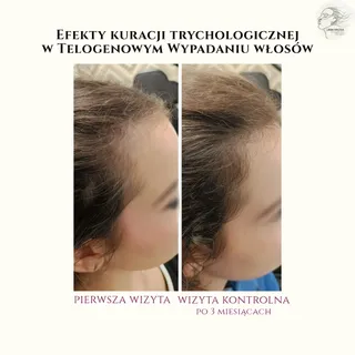 ❗Efekty terapii w telogenowym wypadaniu włosów u młodej klientki. 

Po 3 miesiącach uzyskałyśmy:
✔️p