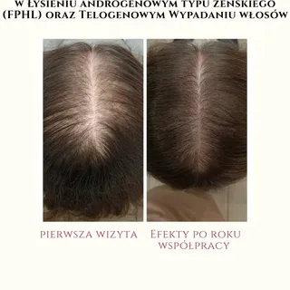 ❗Efekty kuracji trychologicznej w Łysieniu Androgenowym Typu Żeńskiego (FPHL) oraz Telogenowym Wypad