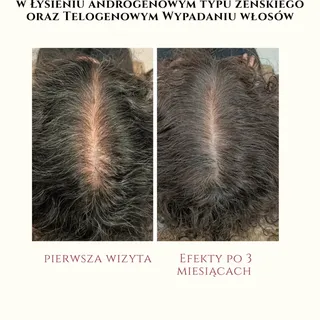 ❗ EFEKTY KURACJI TRYCHOLOGICZNEJ

W tym przypadku sama byłam zaskoczona efektami kuracji. 🙆🏼‍♀️

J