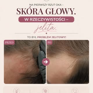 Pogorszenie stanu skóry głowy (i nie tylko) to często wyraźny objaw - a nie przyczyna 

W tym przypa