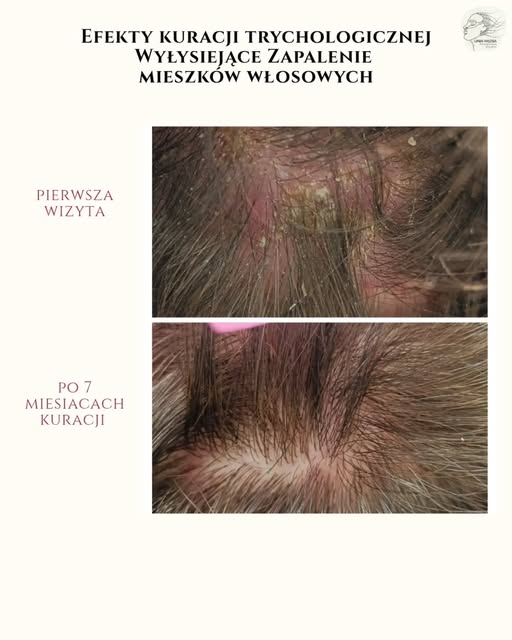 ❗EFEKTY KURACJI TRYCHOLOGICZNEJ 
ZE WSPÓŁPRACY Z DIETETYKIEM KLINICZNYM I DERMATOLOGIEM 

Liczne gru
