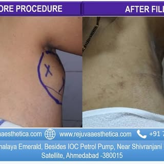 A 50 year old female pt walked into our clinic having bilateral huge axillary lipoma  which is gradu