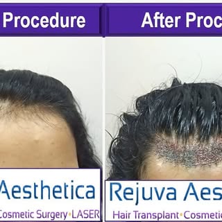 Although hair loss is often perceived as being a “male problem”, there are many women who also suffe
