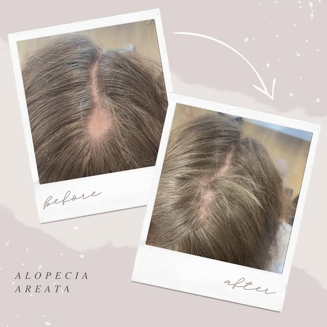 Her doctor said:
“I’ve never seen spots grow back this quickly.”

This wasn’t random.

This client c