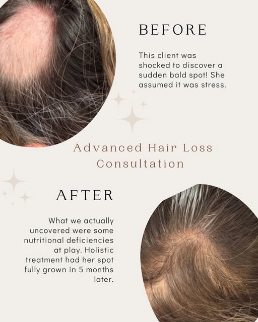 Sometimes hair loss isn’t “just stress.”
This client came in after discovering a sudden bald spot an