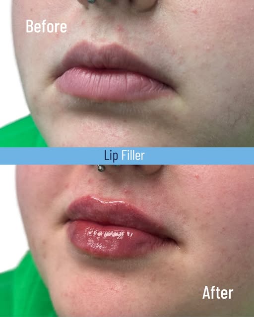 Subtle enhancement. Beautifully balanced results. 💋

Lip filler is designed to enhance your natural