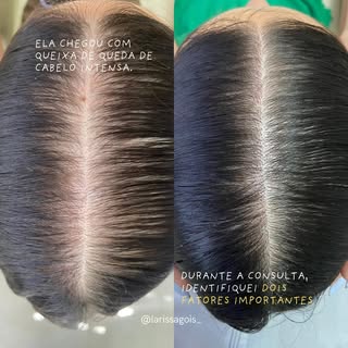 Antes & Depois 

Queda de cabelo nem sempre tem uma única causa. Neste caso, o uso de Tirzepatida le