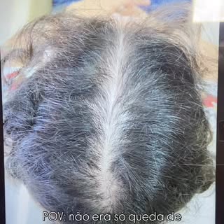 Muita gente acha que é só uma fase, um pouco mais de queda no banho ou ao pentear. Mas quando o fio 