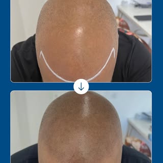 Effet rasé : 
La tricopigmentation redessine la ligne frontale, booste la confiance.

#Tricopigmenta