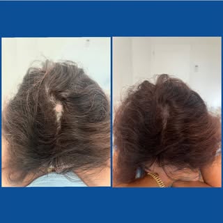 La micropigmentation permet d’atténuer un défaut, dans ce cas, une légère pelade. #pelade #stress #c