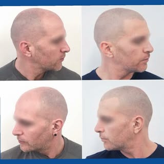 L’effet rasé parfait, naturellement. La tricopigmentation redessine le cuir chevelu pour un résultat