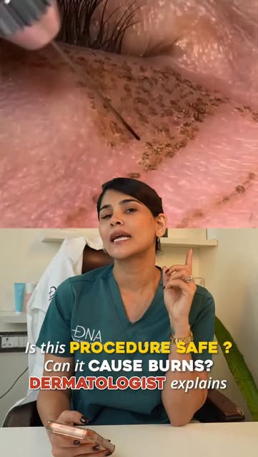 Is this procedure safe ? Can it cause burns ? Dermatologist explains