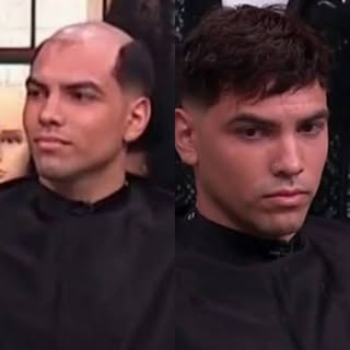 ¿Te estás quedando sin cabello y te da pena que la gente te vea? 👨🏼‍🦲 En #HoyDía te contamos de l