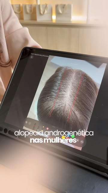 Quando falamos em calvície, é comum imaginar grandes áreas sem cabelo. Mas nem sempre é assim, a Alo