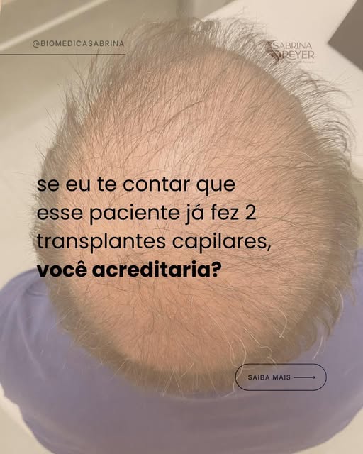 Ele chegou ao consultório já bem calvo e com 2 transplantes capilares no histórico. 

E aqui vai uma