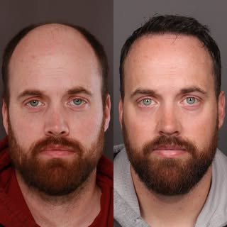 Here are the results following a FUE transplant from one year ago. So happy to see the youthfulness 