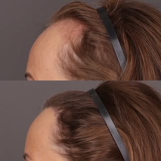 Amazing results for this patient in her mid fifties. This patient is now 1 year post hair transplant
