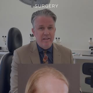 FUE hair transplant (Follicular Unit Extraction) is one of the most advanced hair restoration proced